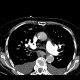 Lung congestion, interstitial edema: CT - Computed tomography