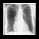 Lung emphysema: X-ray - Plain radiograph