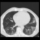 Lung fibrosis, HRCT: CT - Computed tomography