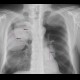 Lung metastases of renal cell carcinoma: X-ray - Plain radiograph