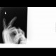 Dislocation of interphalangeal joints: X-ray - Plain radiograph
