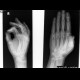 Dislocation of the first interphalangeal and metacarpophalangeal joint: X-ray - Plain radiograph