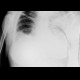 Lymphedema of arm and hemithorax: X-ray - Plain radiograph