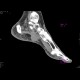 Plantar lymphoma: CT - Computed tomography