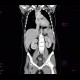 Lymphoma of the lung and spleen: CT - Computed tomography