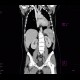 Lymphoma of the lung and spleen: CT - Computed tomography