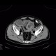 Lymphoma of small bowel, ileum: CT - Computed tomography