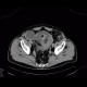 Lymphoma of small bowel, ileum: CT - Computed tomography