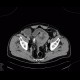 Lymphoma of small bowel, ileum: CT - Computed tomography