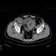 Lymphoma of small bowel, ileum: CT - Computed tomography