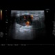 Lymph node in lymphoma: US - Ultrasound