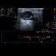 Lymph node in lymphoma: US - Ultrasound