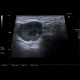 Lymph node in lymphoma: US - Ultrasound