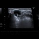 Malignant lymphoma, ultrasound of lymph nodes, correlation with CT and NM: US - Ultrasound