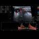 Malignant lymphoma, ultrasound of lymph nodes, correlation with CT and NM: US - Ultrasound