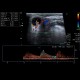 Malignant lymphoma, ultrasound of lymph nodes, correlation with CT and NM: US - Ultrasound