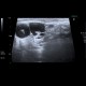 Malignant lymphoma, ultrasound of lymph nodes, correlation with CT and NM: US - Ultrasound