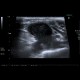 Malignant lymphoma, ultrasound of lymph nodes, correlation with CT and NM: US - Ultrasound
