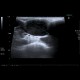 Malignant lymphoma, ultrasound of lymph nodes, correlation with CT and NM: US - Ultrasound