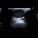 Malignant lymphoma, ultrasound of lymph nodes, correlation with CT and NM: US - Ultrasound