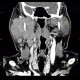 Lymphoma of parotid gland, lymphadenopathy: CT - Computed tomography