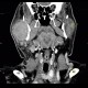 Lymphoma of parotid gland, lymphadenopathy: CT - Computed tomography