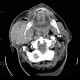 Lymphoma of parotid gland, lymphadenopathy: CT - Computed tomography