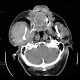 Lymphoma of parotid gland, lymphadenopathy: CT - Computed tomography