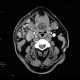 Lymphoma of parotid gland, lymphadenopathy: CT - Computed tomography