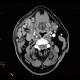 Lymphoma of parotid gland, lymphadenopathy: CT - Computed tomography