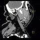 Lymphoma of parotid gland, lymphadenopathy: CT - Computed tomography