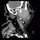 Lymphoma of parotid gland, lymphadenopathy: CT - Computed tomography