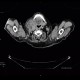 Lymphoma of parotid gland, lymphadenopathy: CT - Computed tomography