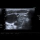 Lymphocytic thyroiditis: US - Ultrasound