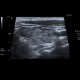 Lymphocytic thyroiditis: US - Ultrasound