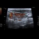 Lymphocytic thyroiditis: US - Ultrasound