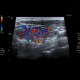 Lymphocytic thyroiditis: US - Ultrasound