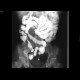 Crohn's disease, aboral ileum, enteroclysis: RF - Fluoroscopy