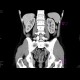 Crohn's disease, ileocecal resection, subtotal colectomy, recurrence: CT - Computed tomography