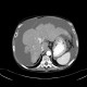 Liver cirrhosis, macronodular, ascites, massive: CT - Computed tomography