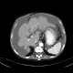 Liver cirrhosis, macronodular, ascites, massive: CT - Computed tomography