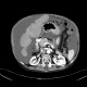 Liver cirrhosis, macronodular, ascites, massive: CT - Computed tomography