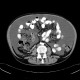 Liver cirrhosis, macronodular, ascites, massive: CT - Computed tomography