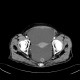 Liver cirrhosis, macronodular, ascites, massive: CT - Computed tomography