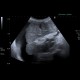 Liver cirrhosis, macronodular, ascites, massive: US - Ultrasound