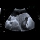 Liver cirrhosis, macronodular, ascites, massive: US - Ultrasound