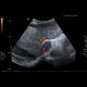 Liver cirrhosis, macronodular, ascites, massive: US - Ultrasound