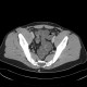 Meckel's diverticulum: CT - Computed tomography