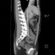 Meckel's diverticulum: CT - Computed tomography