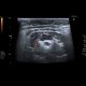 Cyst, medial cervical cyst - coronal plane: US - Ultrasound